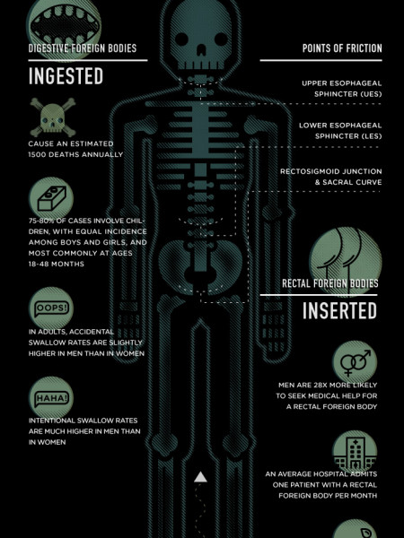 Bizarre Objects Extracted from Humans Infographic