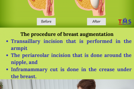 Breast Augmentation Turkey - Turkish Medical Services Infographic