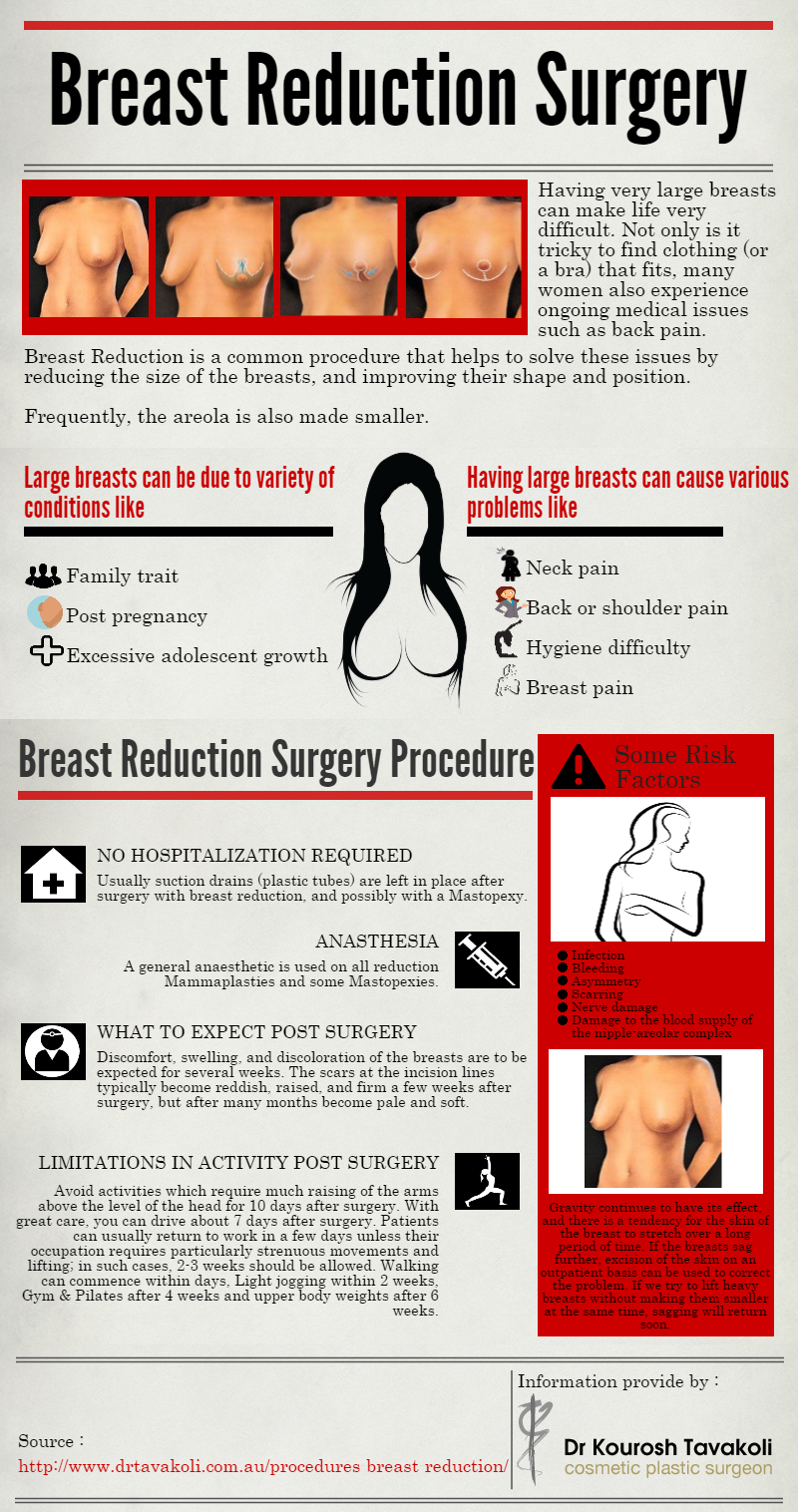 Breast reduction Australia: Women with very large breasts face