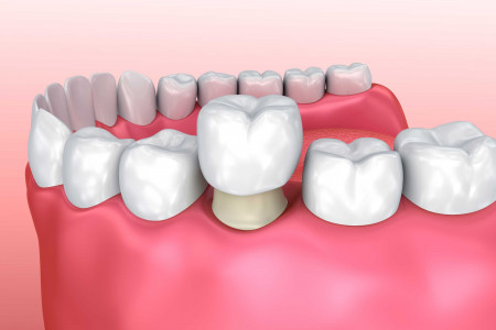 Dental Crown Infographic