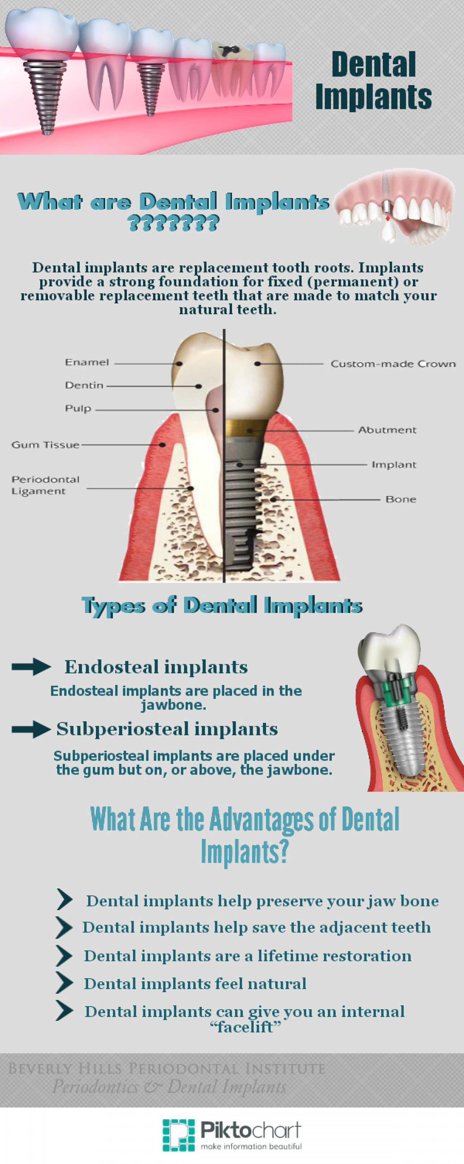 Dental Implants Infographic