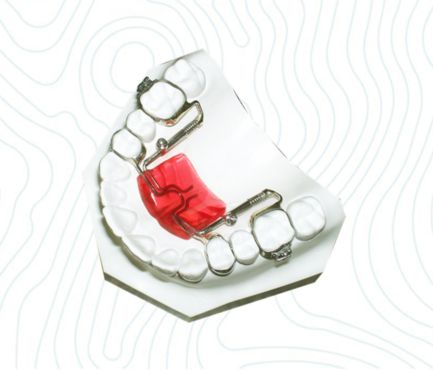 Distal Jet Orthodontic Appliance | China Orthodontic Infographic