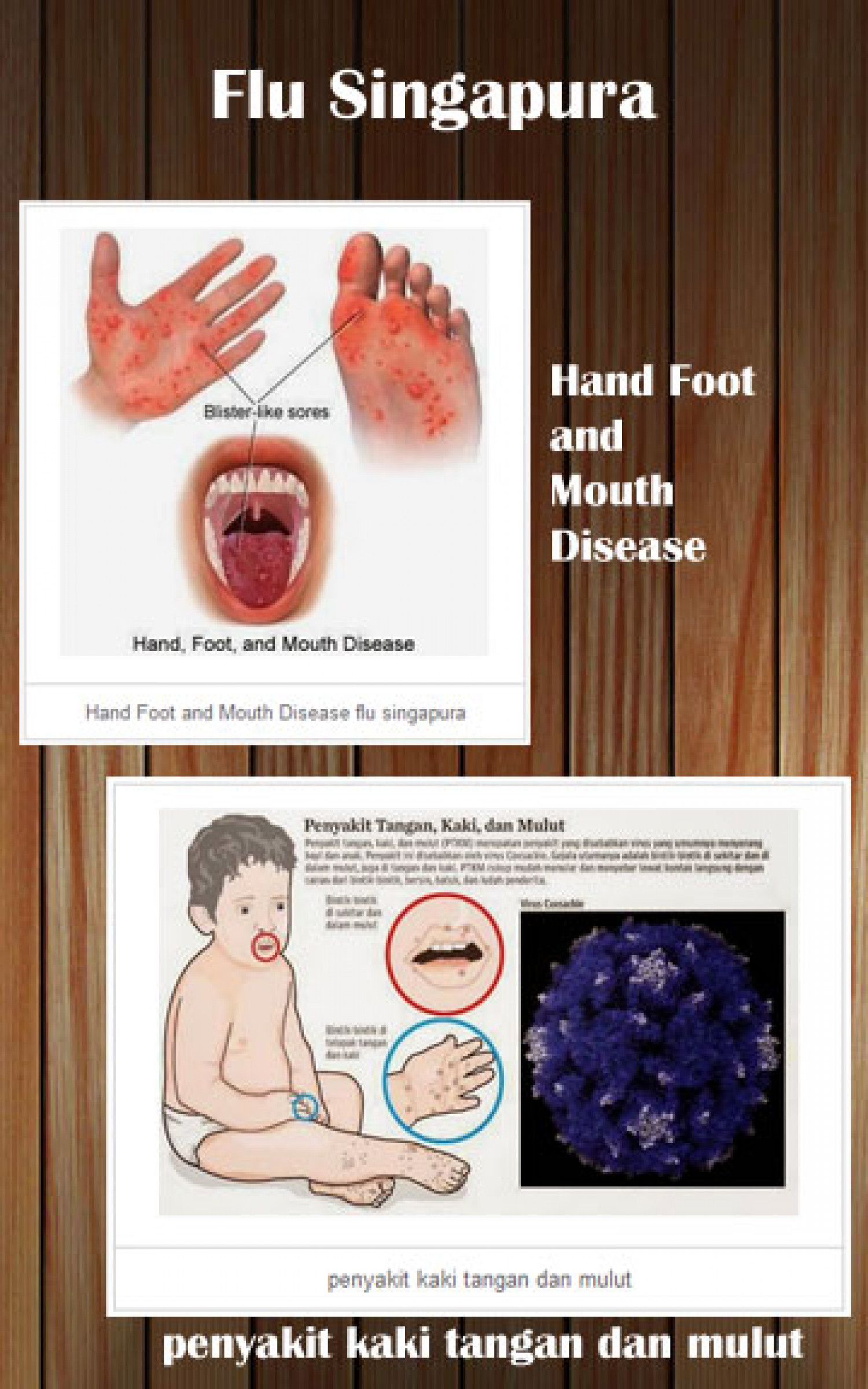 Flu Singapura Infographic