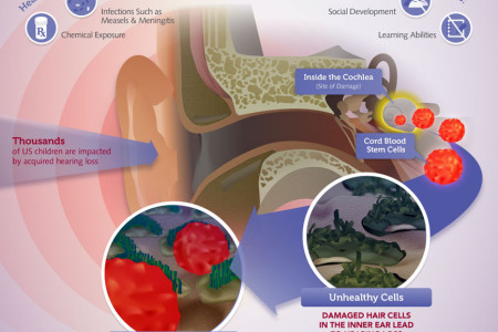 Hearing Loss at a Glance: The causes, impacts and how cord blood stem cells may help Infographic