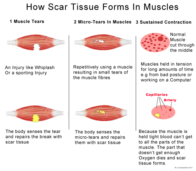 How Scar Tissue Forms In Muscles Infographic