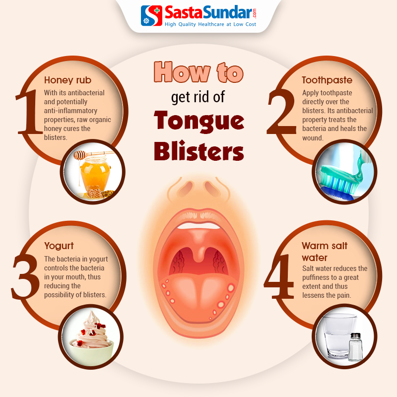 How To Get Rid Of Tongue Blisters | Visual.ly