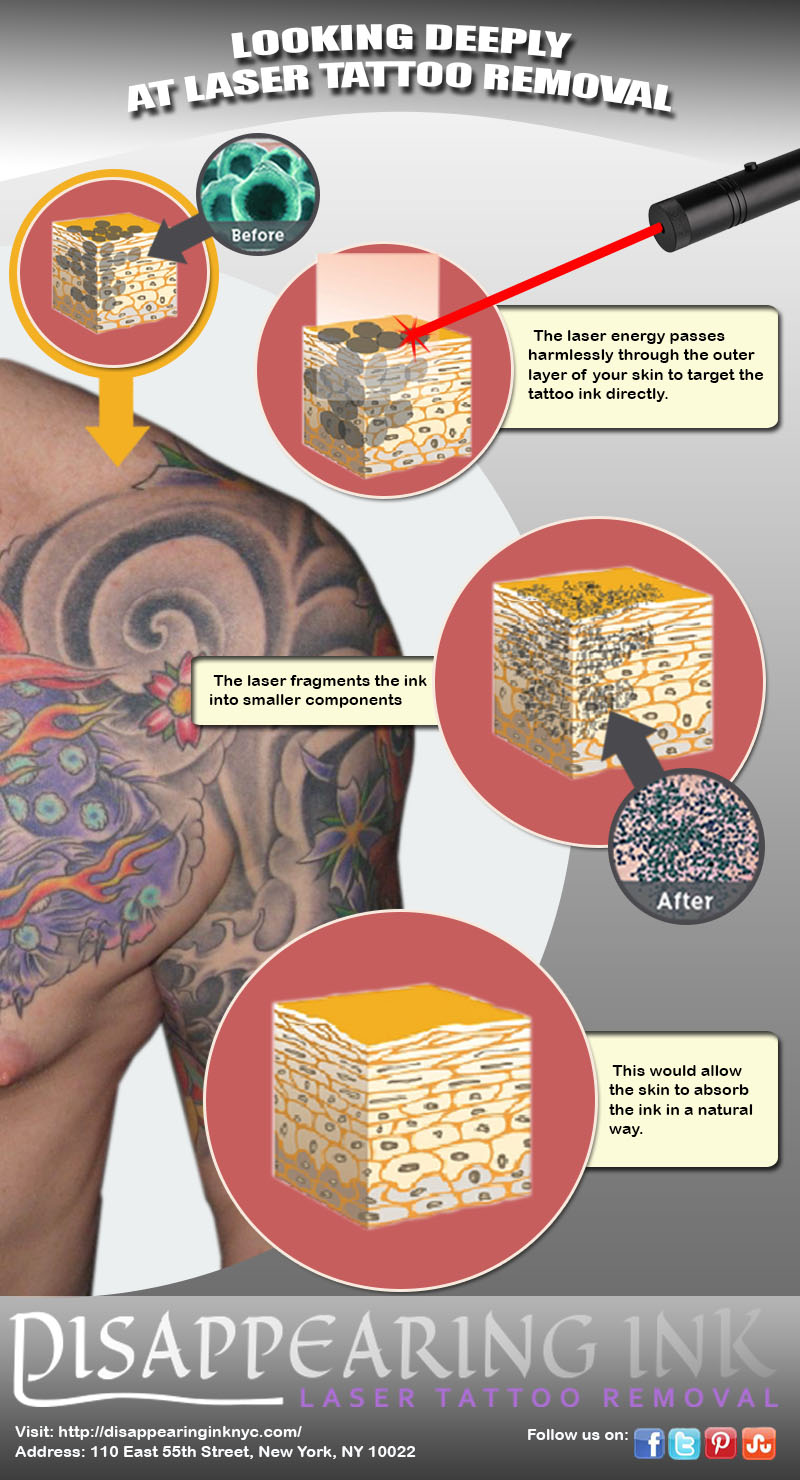 Painless Tattoo Removal San Diego Laser Tattoo Removal