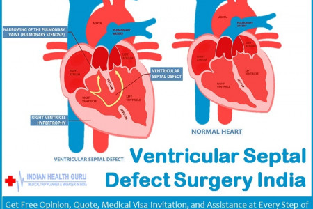 New Surgical Approach to Device Closure with Ventricular Septal Defect Surgery India The VSD operation cost in India  Infographic