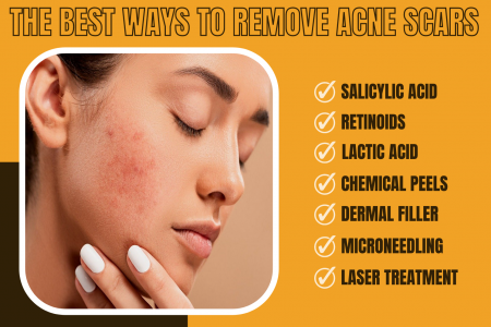 The Best Ways to Remove Acne Scars. Infographic
