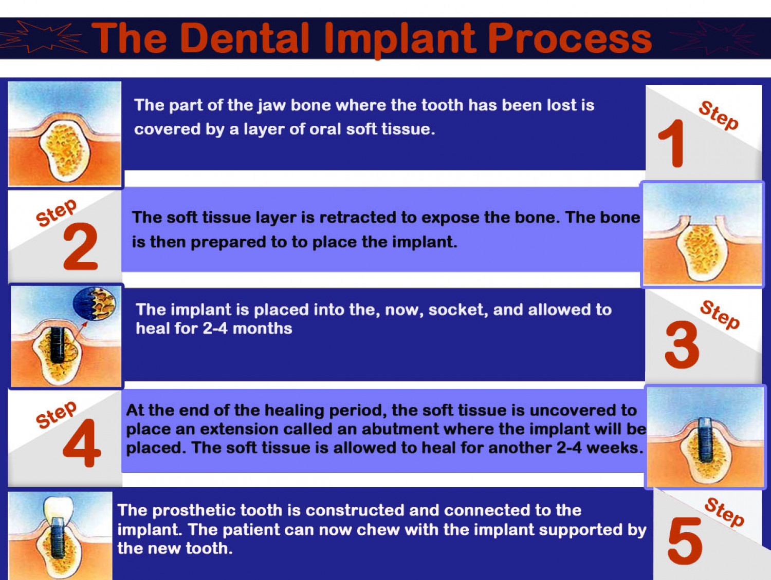 The Dental Implant Process Infographic