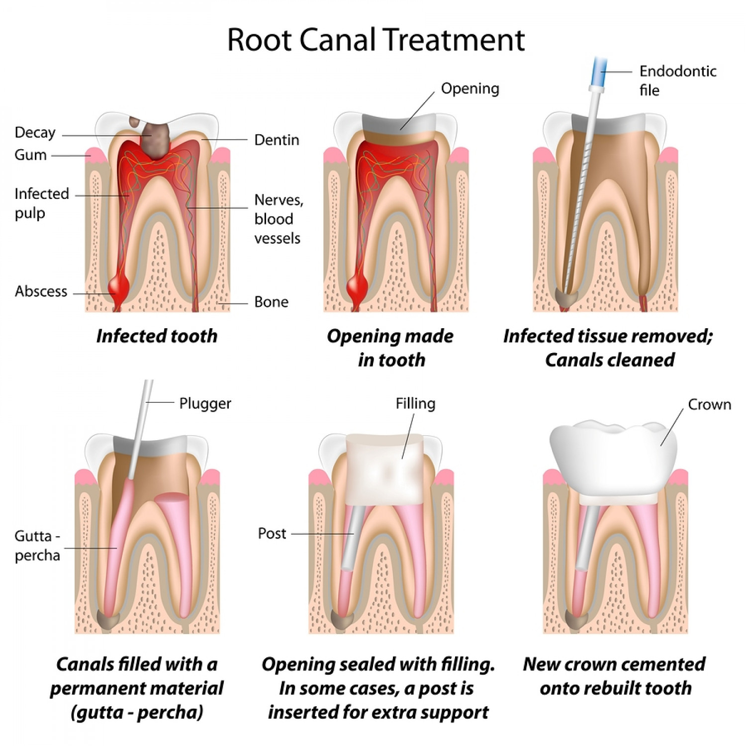 Root Canal Treatment Infographic