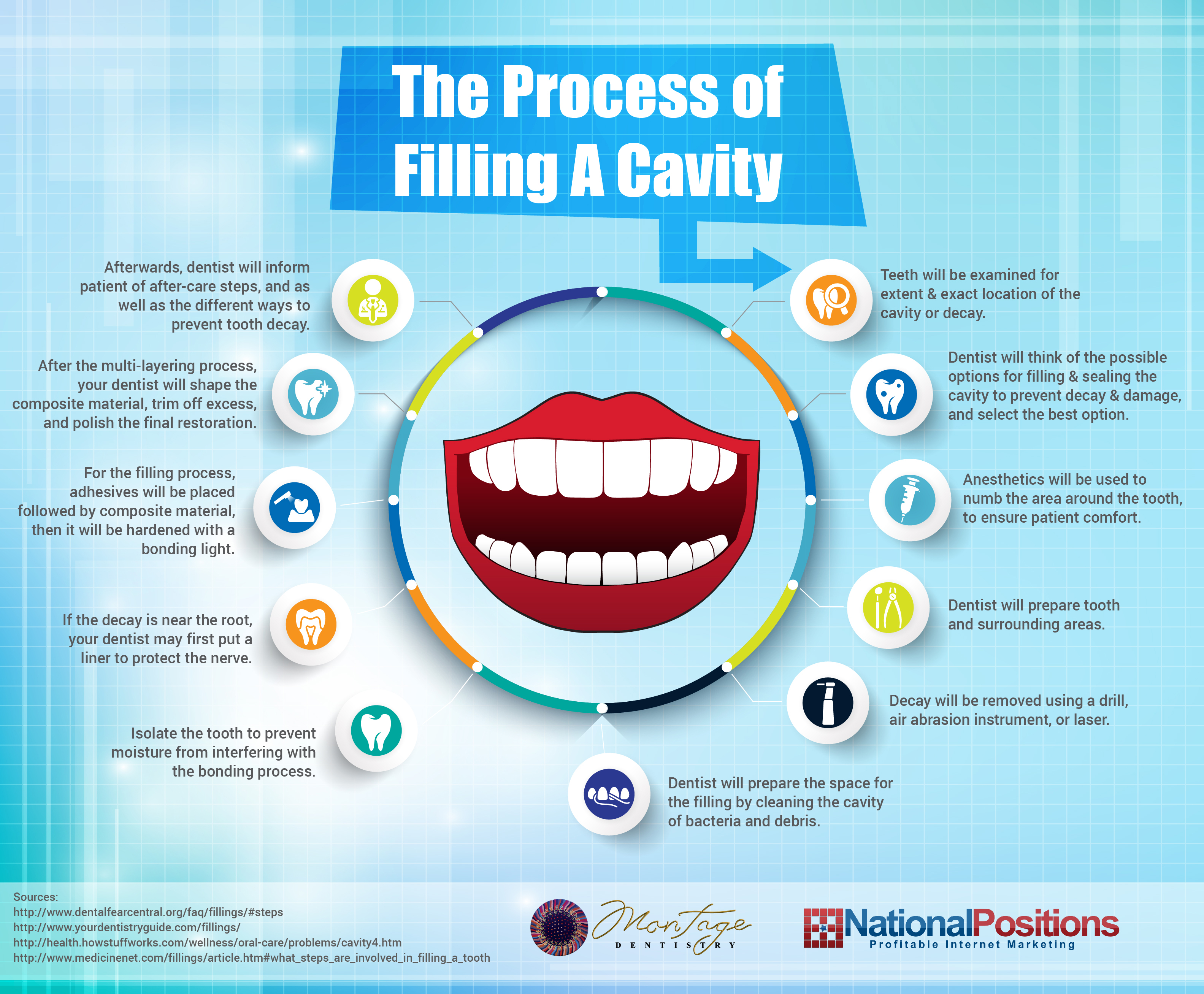 Step-by-Step Dental Filling Procedure: How Does It Work? - Mint
