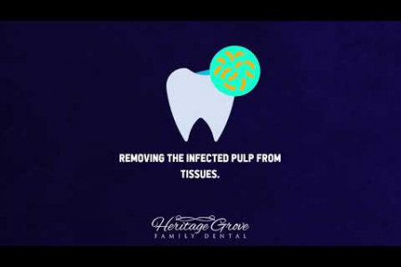 The Process of Root Canal Plainfield IL Dentists Follow Infographic