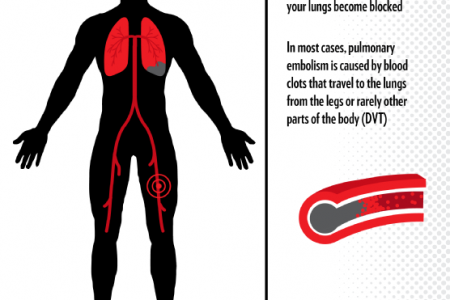 Understanding Anticoagulant Therapy  Infographic