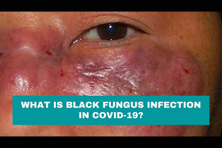 What is Black Fungus Infection in Covid-19? Infographic